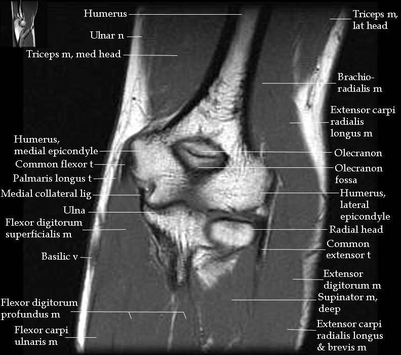 Mri Anatomy Elbow Joint At Alice Novotny Blog
