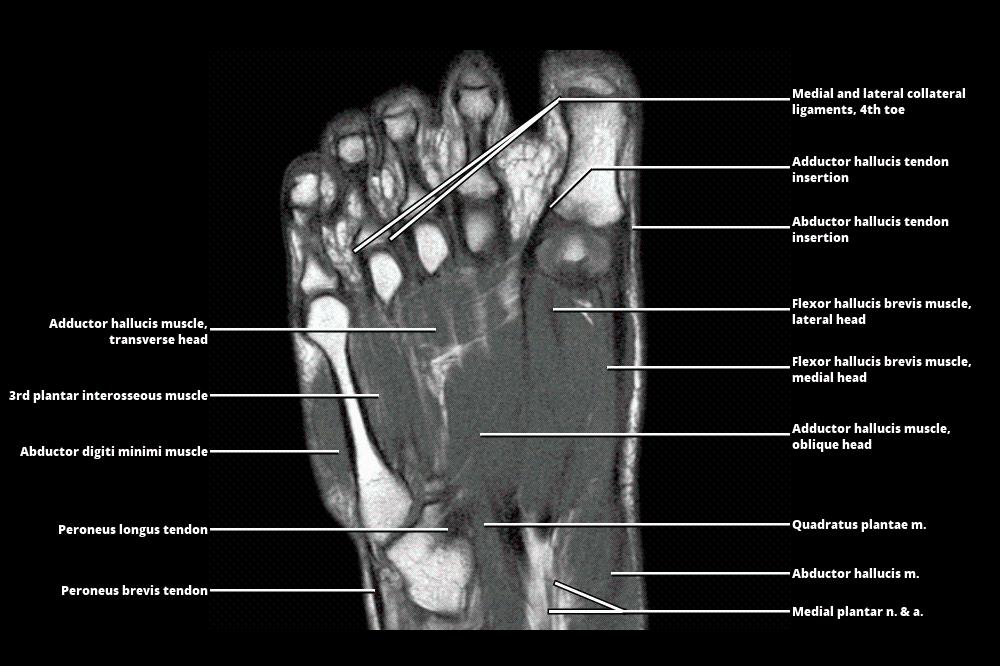 Mri Foot