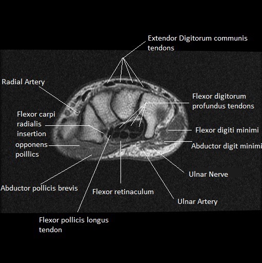 Abductor Digiti Minimi Mri