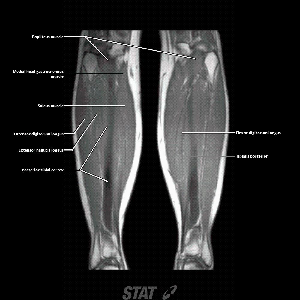 Mri Leg