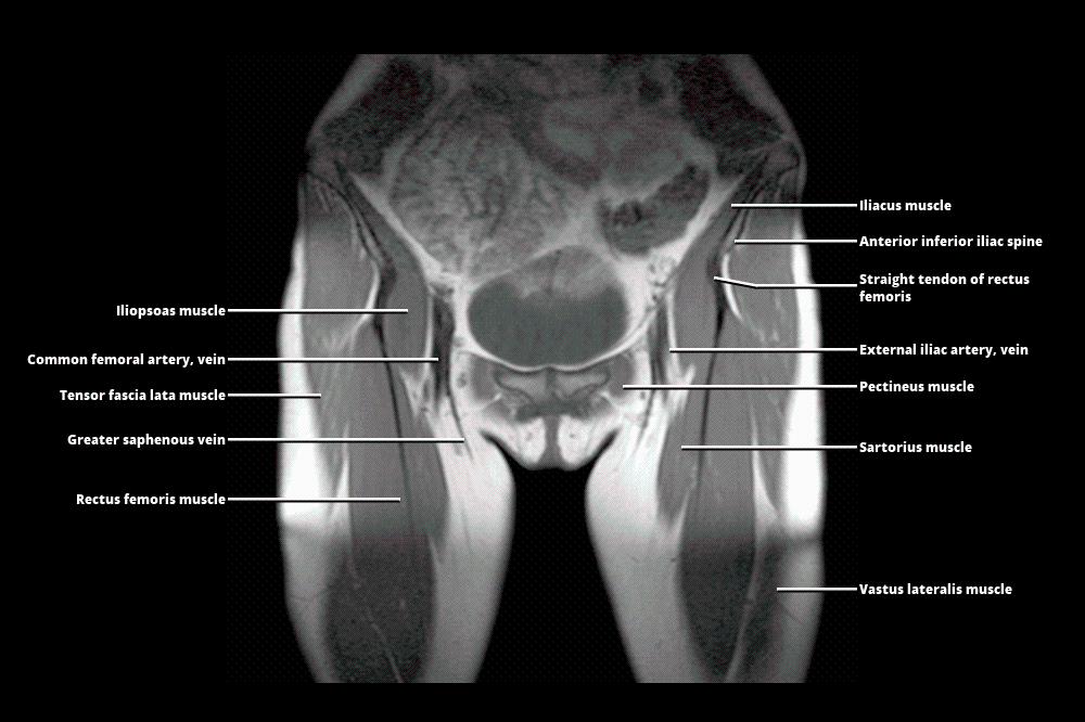 MRI PELVIS
