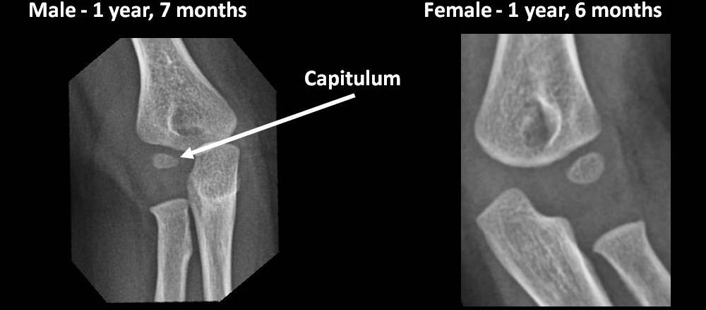 Elbow Ossifications Centers